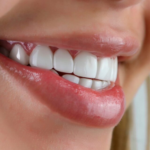 https://qsmiledental.com/wp-content/uploads/2024/05/CAVITY-4-10-640x640.jpeg