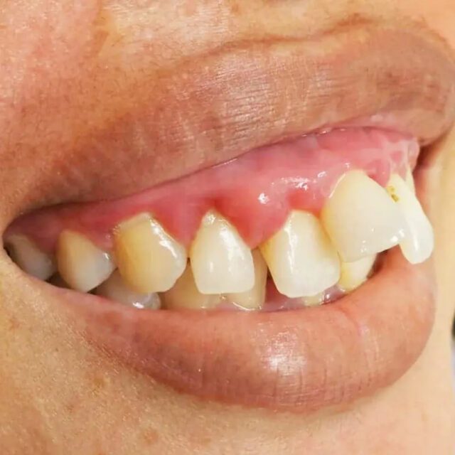 https://qsmiledental.com/wp-content/uploads/2024/05/CAVITY-4-5-640x640.jpeg