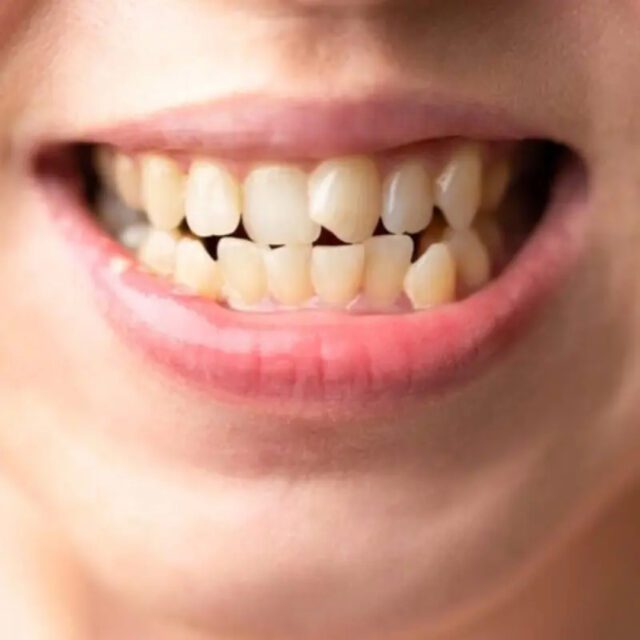 https://qsmiledental.com/wp-content/uploads/2024/05/CAVITY-4-6-640x640.jpeg