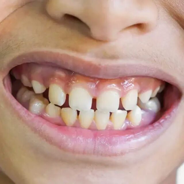 https://qsmiledental.com/wp-content/uploads/2024/05/CAVITY-4-7-640x640.jpeg