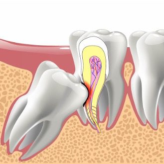 https://qsmiledental.com/wp-content/uploads/2024/05/Cabut-gigi-dewasa-dengan-dokter-gigi-spesialis.jpg