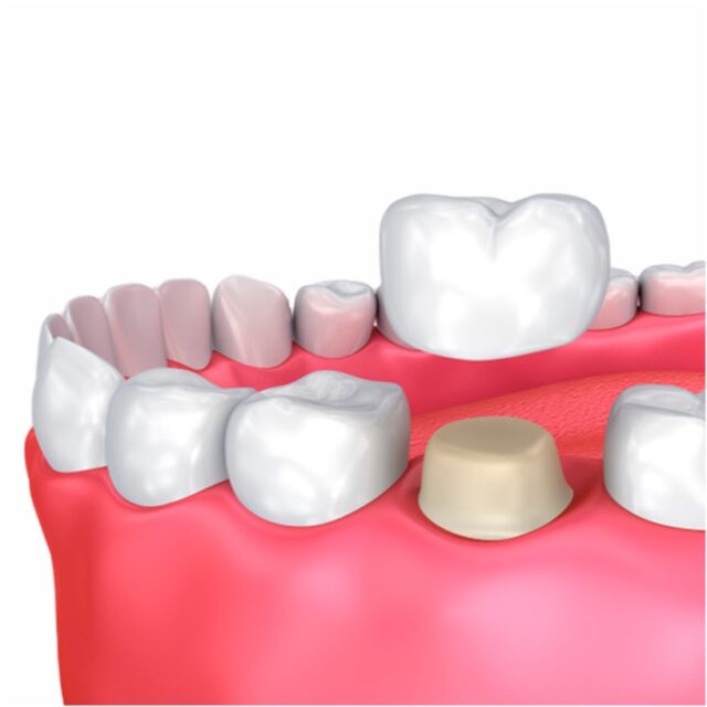 https://qsmiledental.com/wp-content/uploads/2024/05/Crown-Implan-Gigi-640x640.jpg