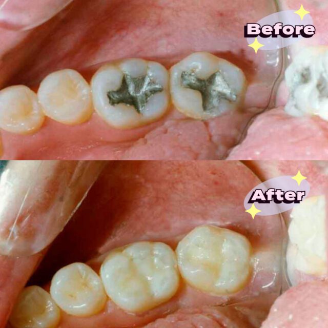 https://qsmiledental.com/wp-content/uploads/2024/05/Dental-Filling-6-1-640x640.jpeg