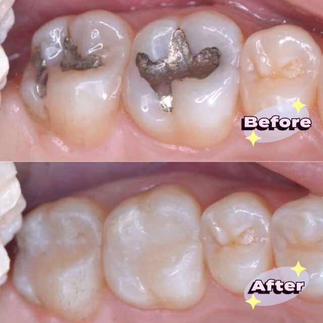 https://qsmiledental.com/wp-content/uploads/2024/05/Dental-Filling-6-2-640x640.jpeg