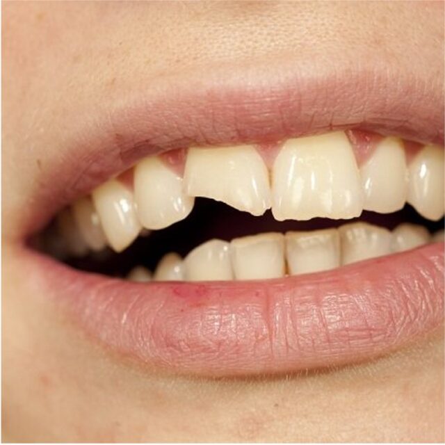 https://qsmiledental.com/wp-content/uploads/2024/05/Gigi-patah-640x640.jpg