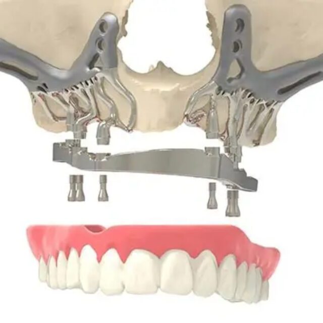 https://qsmiledental.com/wp-content/uploads/2024/05/Implan-Gigi-5-1-640x640.jpeg