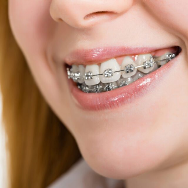 https://qsmiledental.com/wp-content/uploads/2024/05/Ortho-Metal-640x640.jpeg