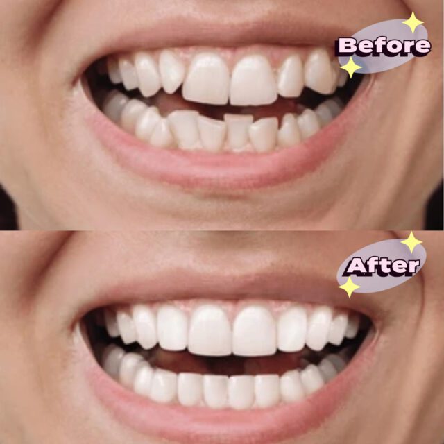 https://qsmiledental.com/wp-content/uploads/2024/05/Scaling-6-2-640x640.jpeg