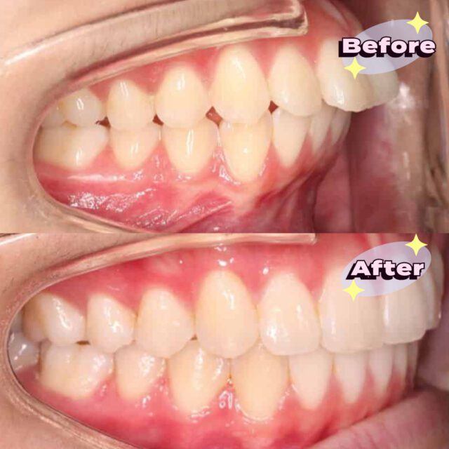 https://qsmiledental.com/wp-content/uploads/2024/05/Scaling-6-3-640x640.jpeg