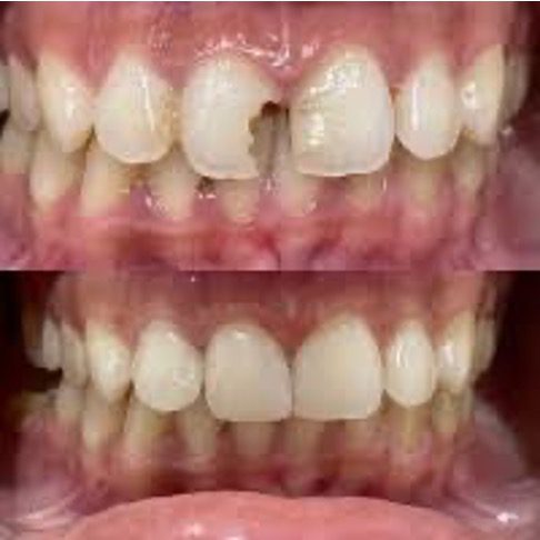 https://qsmiledental.com/wp-content/uploads/2024/05/Tambal-komposit-.jpg