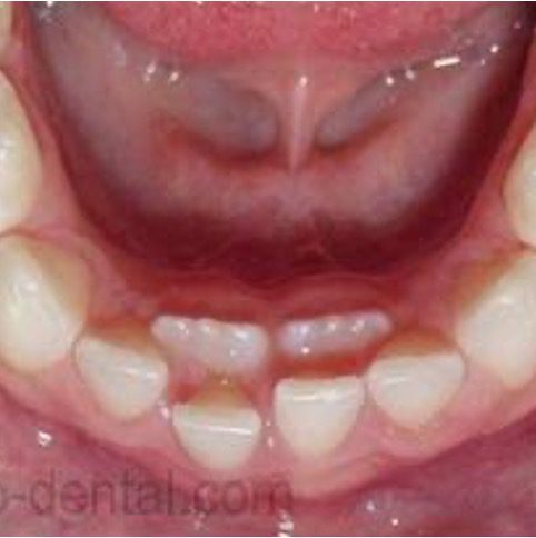 https://qsmiledental.com/wp-content/uploads/2024/05/gigi-berlebih.jpg