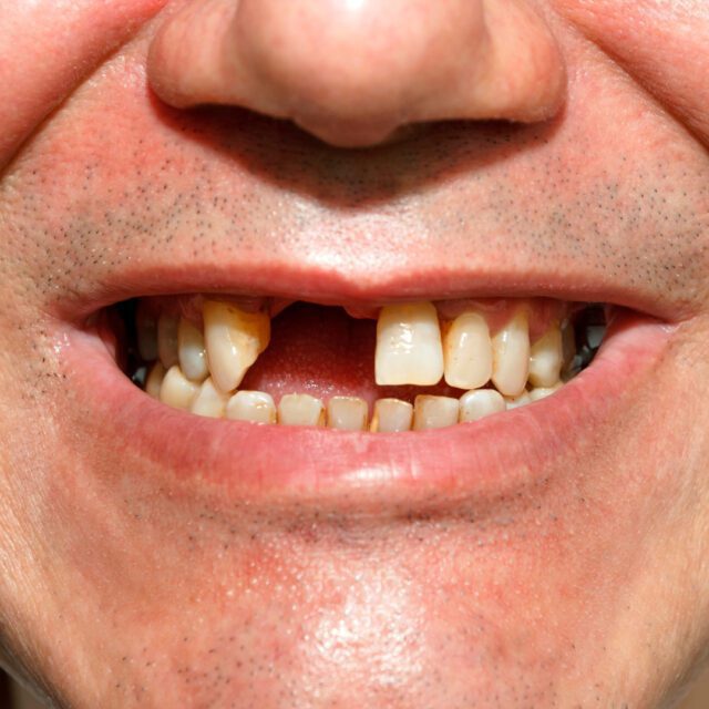 https://qsmiledental.com/wp-content/uploads/2024/05/gigi-tiruan-4-2-640x640.jpeg