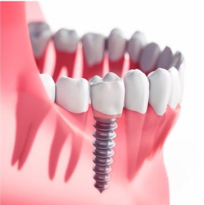 https://qsmiledental.com/wp-content/uploads/2024/05/impan-2.jpg