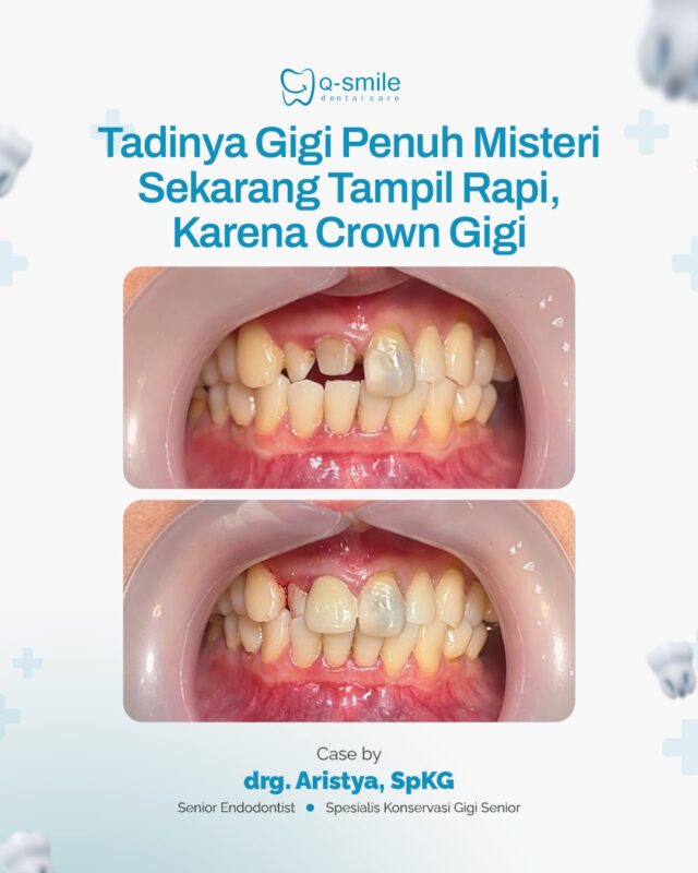 Senyum Percaya Diri Lagi dengan Crown Gigi Tanjungpinang!