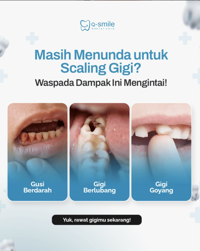 Jangan Tunda! Pahami Pentingnya Scaling Gigi & Hindari Dampak Karang Gigi Berbahaya