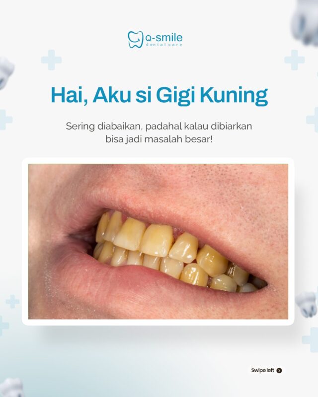 Gigi Kuning Bikin Ilfeel? Kenali Penyebab & Cara Mengatasinya!