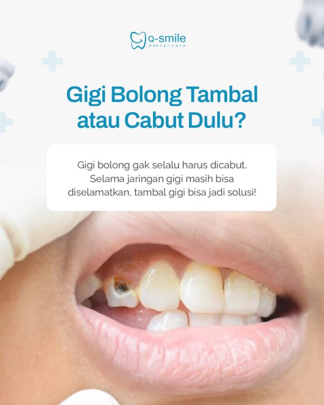 Gigi Berlubang: Kapan Harus Ditambal, Kapan Perlu Dicabut?